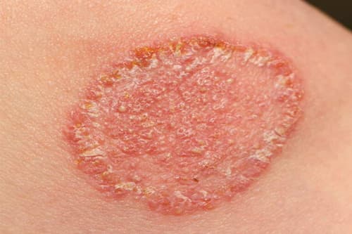 Fungal Infection