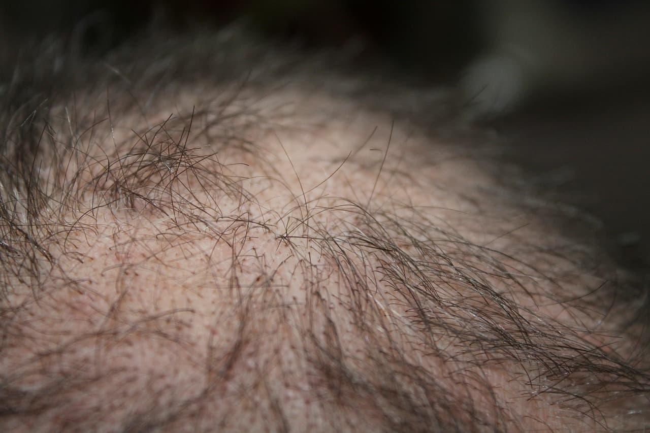 Hair Fall